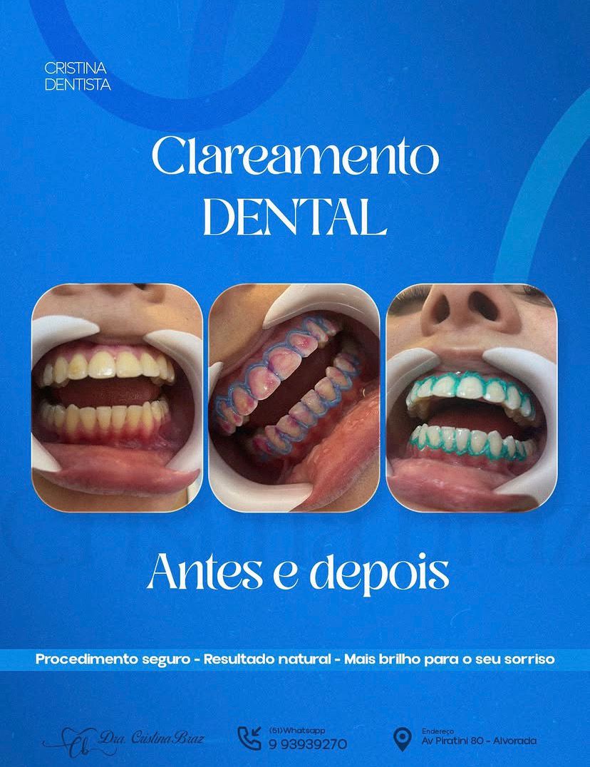 Clareamento dental antes e depois realizado pela Dra. Cristina Braz